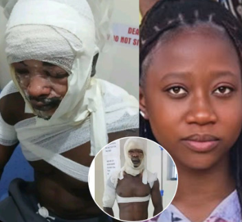 Nairobi Man Hospitalised After Alleged Hot Water Attack by Girlfriend